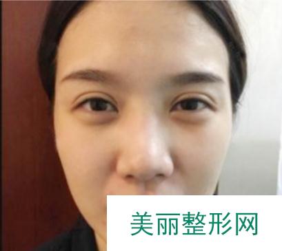 成都美立方整形医院隆鼻案例 术后恢复果反馈 