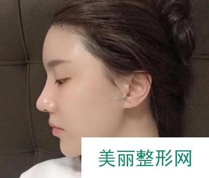 成都美立方整形医院隆鼻案例 术后恢复果反馈 