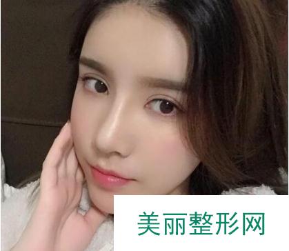 成都美立方整形医院隆鼻案例 术后恢复果反馈 