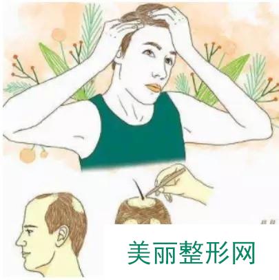 上海科发源植发：记录一下我做发际线种植的历程（图） 