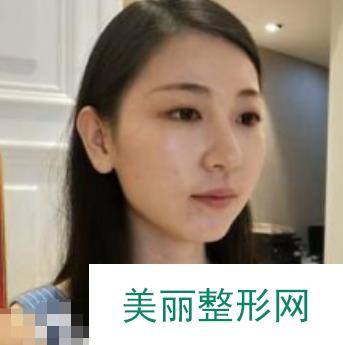 哈医大一院整形美容科磨骨案例：果对比|恢复记录分享