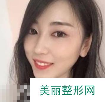 哈医大一院整形美容科磨骨案例：果对比|恢复记录分享