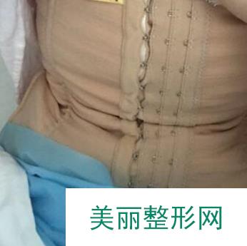 南昌二附院整形美容科吸脂瘦腰腹：小肚腩变身马甲线