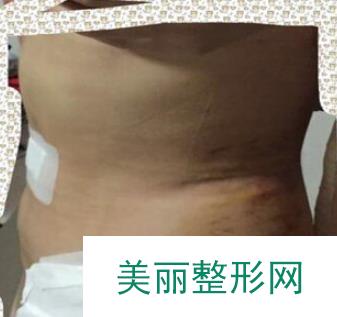 南昌二附院整形美容科吸脂瘦腰腹：小肚腩变身马甲线