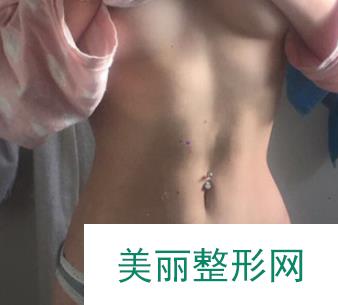 南昌二附院整形美容科吸脂瘦腰腹：小肚腩变身马甲线