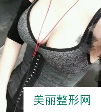 浙二医院整形美容科隆胸真实果曝光，自然柔软不影响哺乳