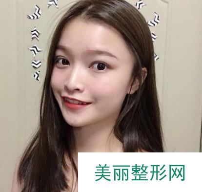 北京沃尔整形美容医院磨骨日记术后果口碑评价，轻松成小V脸