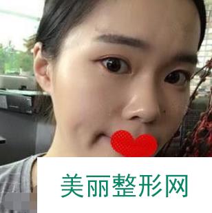 随州市中心医院整形美容科磨骨做的咋样？果线条流畅自然