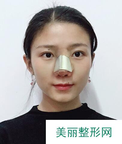 合肥华美整形美容医院隆鼻果真实记录分享，案例实图查看