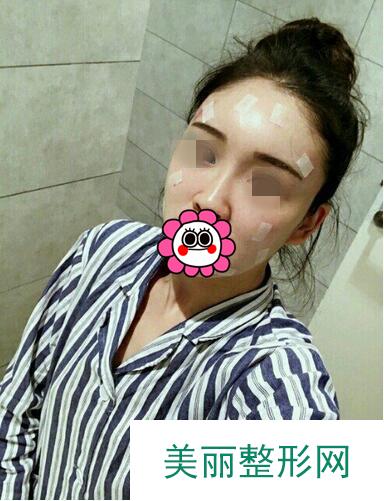 温州艺星医学美容医院自体脂肪填充面部果反馈，饱满自然少女脸