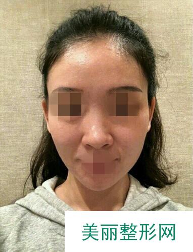 温州艺星医学美容医院自体脂肪填充面部果反馈，饱满自然少女脸