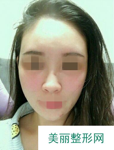 温州艺星医学美容医院自体脂肪填充面部果反馈，饱满自然少女脸