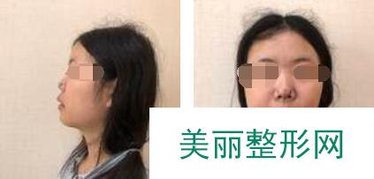 做完鼻子后想起塌鼻子素颜的时候真丑