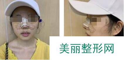 做完鼻子后想起塌鼻子素颜的时候真丑