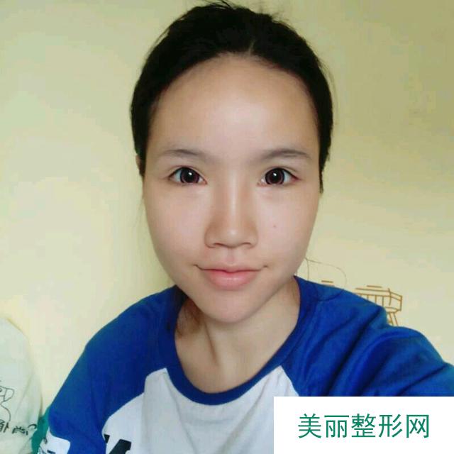 做鼻部手术后，妹子更获华丽欧美风