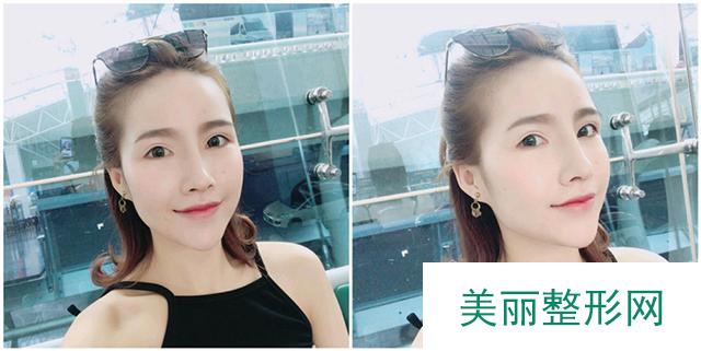 做鼻部手术后，妹子更获华丽欧美风