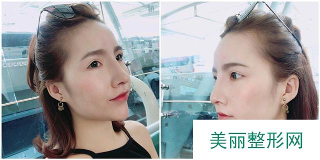 做鼻部手术后，妹子更获华丽欧美风