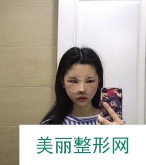 上海九院整形科怎么样？隆鼻+垫下巴案例分享！