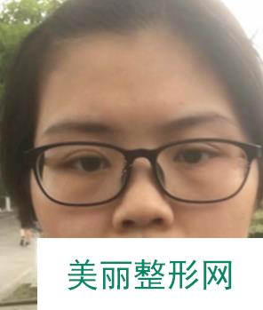 郑大一附院整形科专家隆鼻案例导出实情：前后对比差别大！