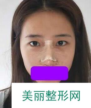 杭州第一人民医院整形科隆鼻怎么样？美丽小翘鼻非我莫属！