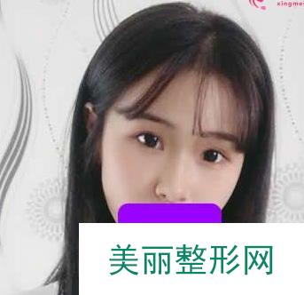 杭州第一人民医院整形科隆鼻怎么样？美丽小翘鼻非我莫属！