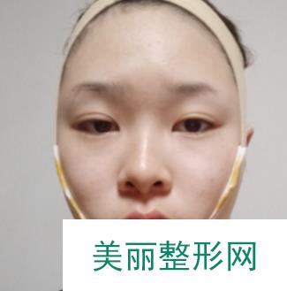 上海华美李志海磨骨怎么样？案例分享：从女汉子到少女的蜕变！