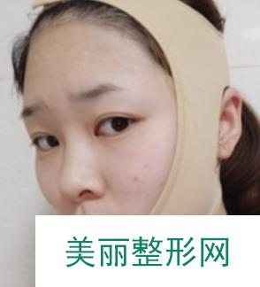 上海华美李志海磨骨怎么样？案例分享：从女汉子到少女的蜕变！