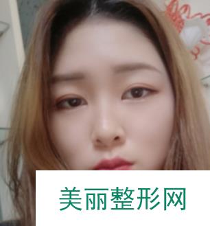 上海华美李志海磨骨怎么样？案例分享：从女汉子到少女的蜕变！