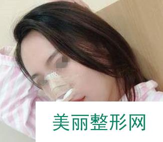 长沙爱思特吴蒙隆鼻案例反馈：三个月果图安排上！