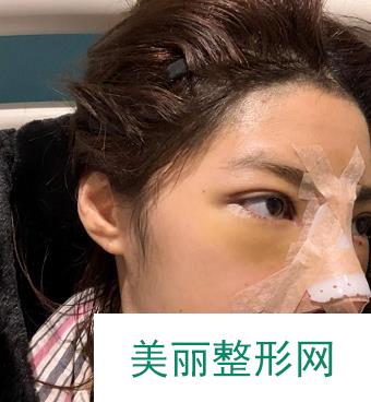 广州美莱隆鼻案例反馈，肋软骨隆鼻果更好！