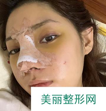 广州美莱隆鼻案例反馈，肋软骨隆鼻果更好！