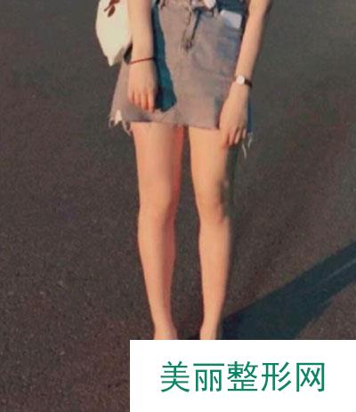 天津维美医疗美容医院做的吸脂瘦大腿