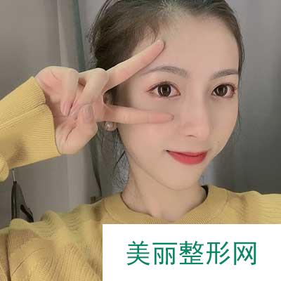 在雅美整形医院做的双眼皮整形手术 术后第7天果很不错