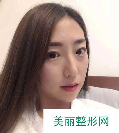 到和颜美帕找刘喆做的白瓷娃娃 术后15天果很好