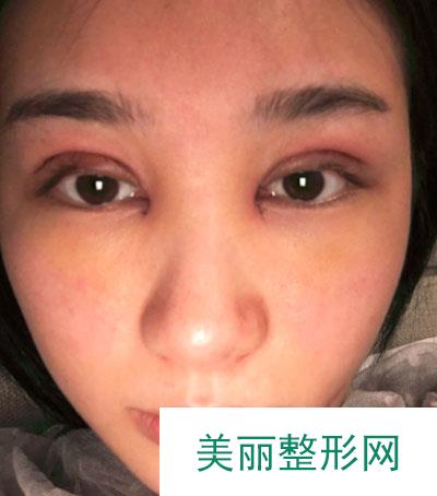 厦门华美医疗美容门诊部眼部多项案例