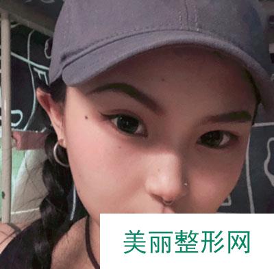 天津维美医疗美容医院鼻部多项案例