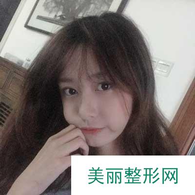 在珠海九龙找王继红做的隆鼻 终于拥有了高挺鼻子 果真好！