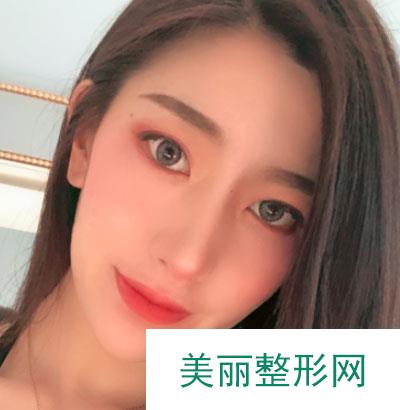 南昌佳美美容医院耳软骨复合隆鼻案例