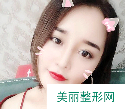 杭州格莱美张霞飞医师双眼皮+隆鼻+面部吸脂 真人案例分享