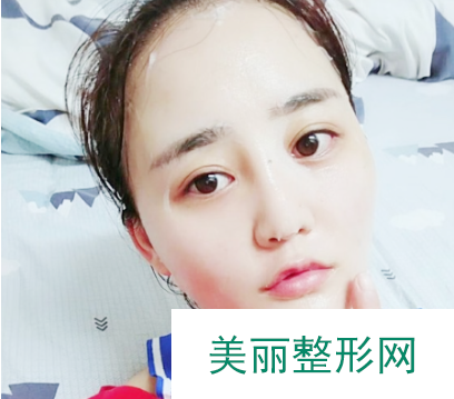 杭州格莱美张霞飞医师双眼皮+隆鼻+面部吸脂 真人案例分享