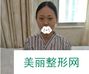 上海九院整形苏薇洁做双眼皮怎么样？60天前后对比图案例分享