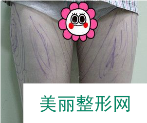 深圳富华万友望做大腿吸脂怎么样？60天前后果真的超乎想象