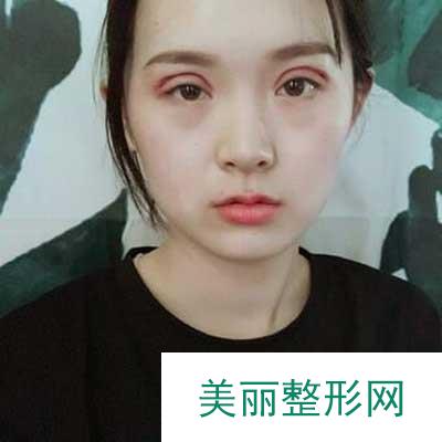 分享我去佛山华美找梁宗建院长做全切双眼皮手术后