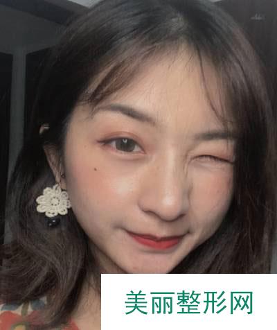 北京美莱医疗美容医院的埋线提升案例