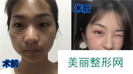 北京美莱医疗美容医院的埋线提升案例