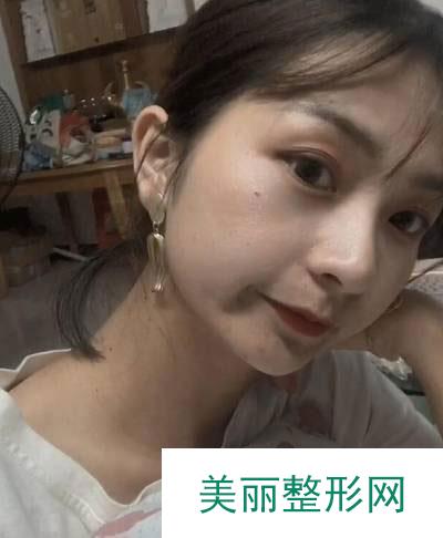 北京美莱医疗美容医院的埋线提升案例