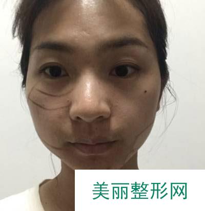 北京美莱医疗美容医院的埋线提升案例