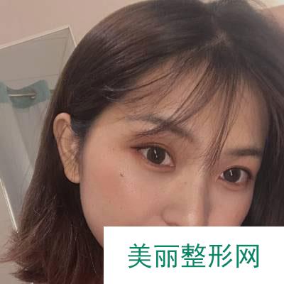 北京美莱医疗美容医院的埋线提升案例