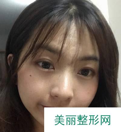 北京美莱医疗美容医院的埋线提升案例