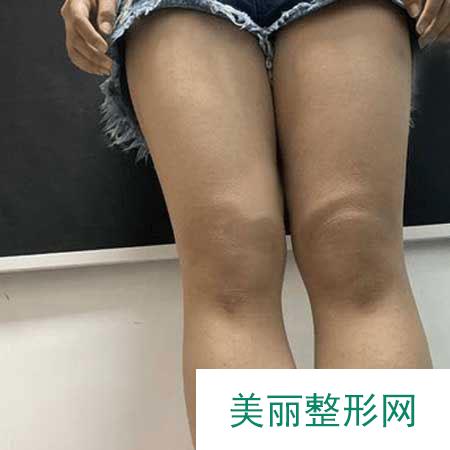 西京医院整形外科的吸脂瘦大腿案例